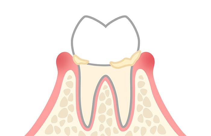 歯肉炎