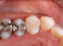 奥歯の詰め物 After