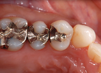 奥歯の詰め物 Before