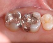 セラミックインレー Before