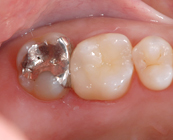 セラミックインレー