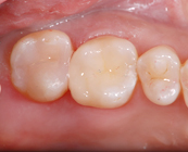 セラミックインレー After