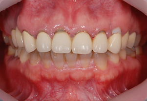 セラミッククラウン