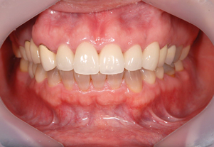 セラミッククラウン